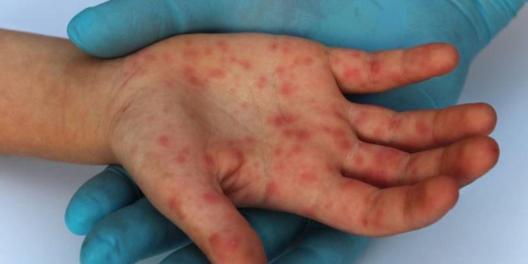 Reportan diez casos de viruela símica en Bolivia en lo que va del año