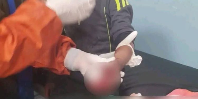 Explosión de petardo deja a un niño sin dedos en el Hospital del Niño de La Paz